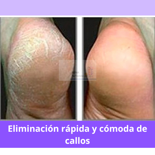 Removedor de Callos Recargable – Pies Suaves al Instante, Sin Salir de Casa